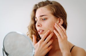 Acne Protocol